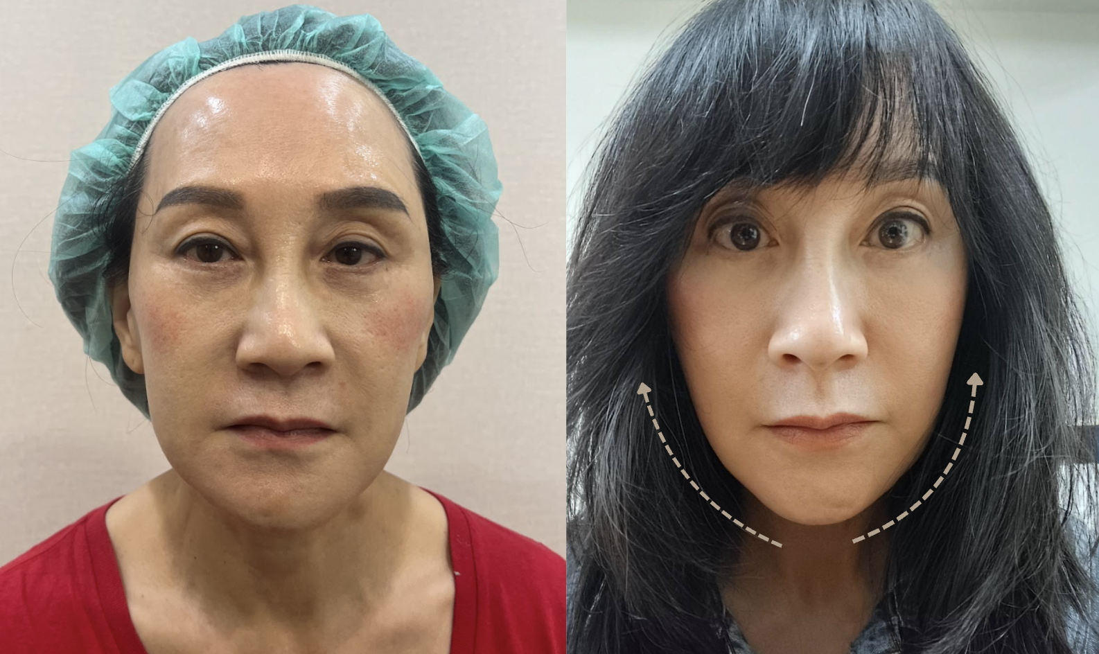 神力拉提效果好嗎?線材優勢、費用、案例分享,讓你告別鬆弛下垂 8 金蘋果美學診所案例 2:改善嘴邊肉