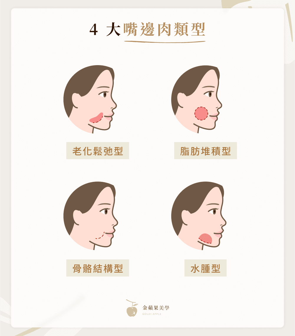 嘴邊肉改善怎麼做?5大醫美療程、4招預防方法不藏私公開! 3 4 大嘴邊肉類型