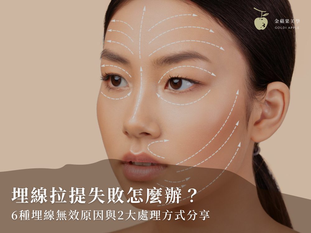 埋線拉提失敗怎麼辦?6種埋線無效原因與2大處理方式分享 2 埋線拉提失敗怎麼辦?6種埋線無效原因與2大處理方式分享