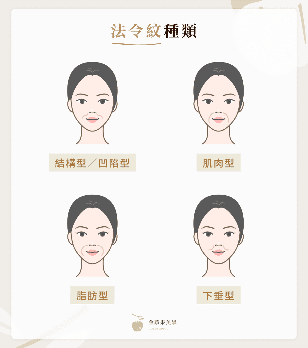 法令紋醫美有哪些?一文帶你掌握4種法令紋類型與適合療程! 3 法令紋種類