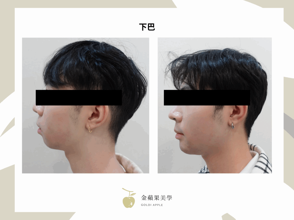 打晶亮瓷下巴好嗎?晶亮瓷(再生針)優缺點及副作用解析 1 晶亮瓷下巴