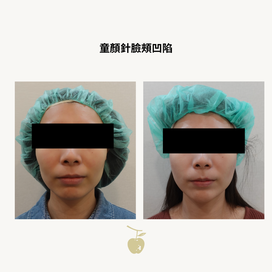 童顏針臉頰凹陷