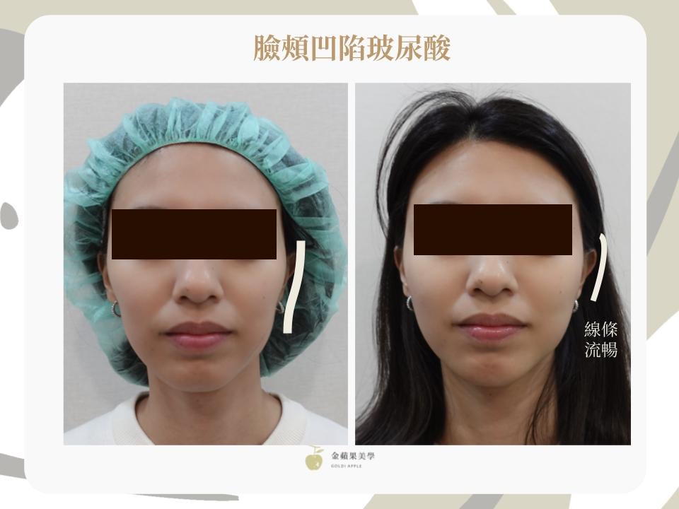 臉頰凹陷玻尿酸