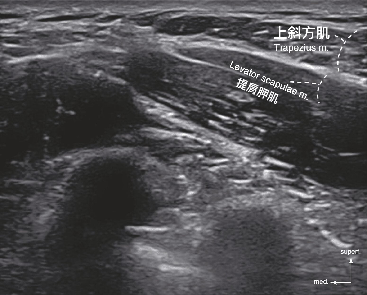 肩頸超音波影像:標示上斜方肌(Trapezius)與提肩胛肌(Levator scapulae)位置