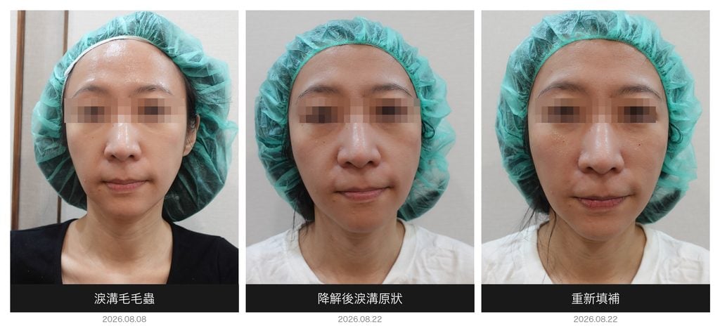 淚溝玻尿酸降解