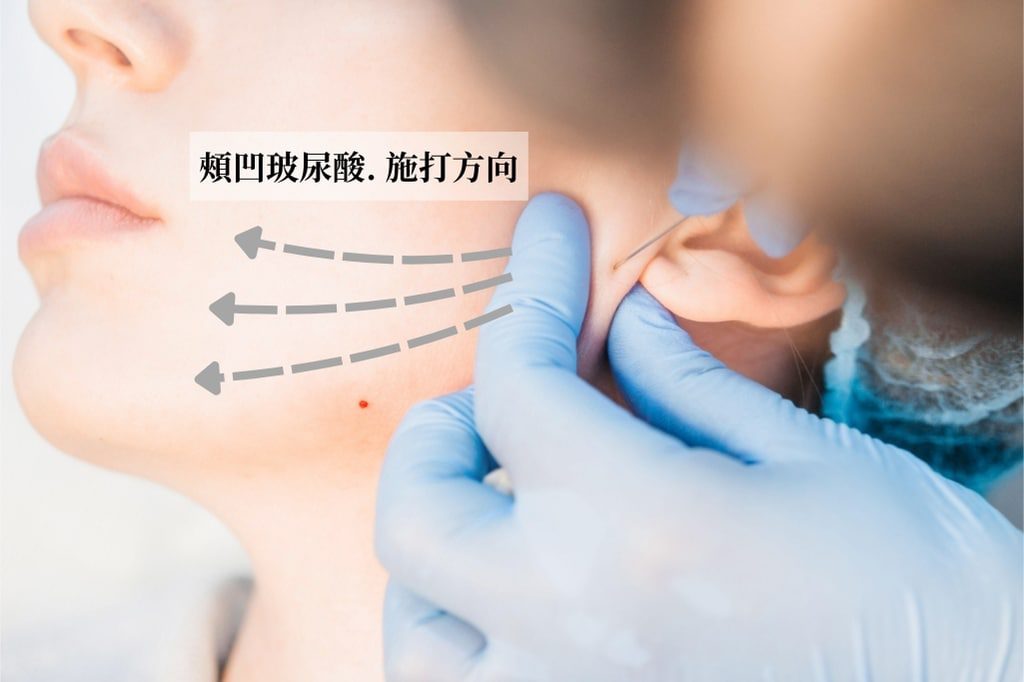 臉頰凹陷玻尿酸