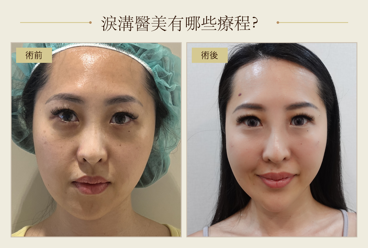 淚溝醫美有哪些療程?7種淚溝改善療程優缺點與費用解析