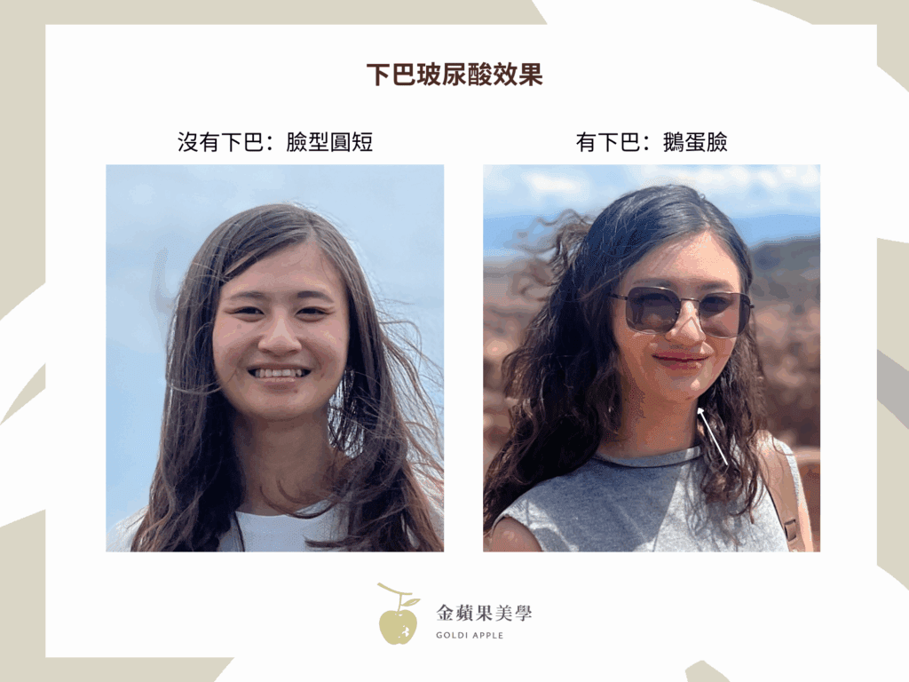 下巴玻尿酸維持多久