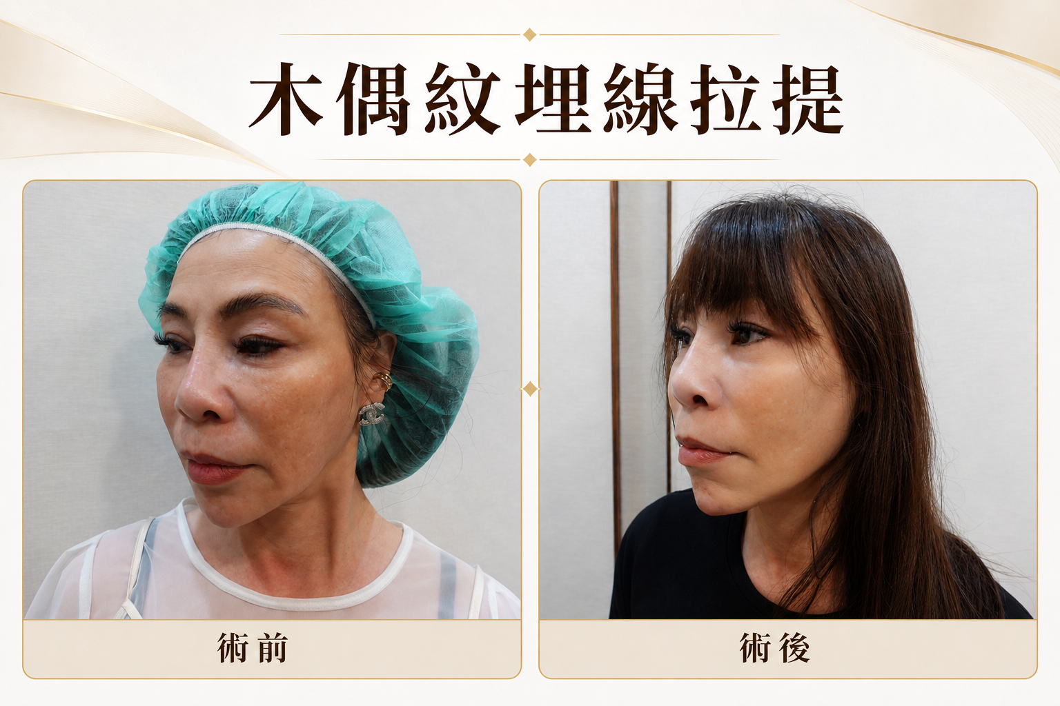木偶紋是什麼?3種木偶紋消除療程比較