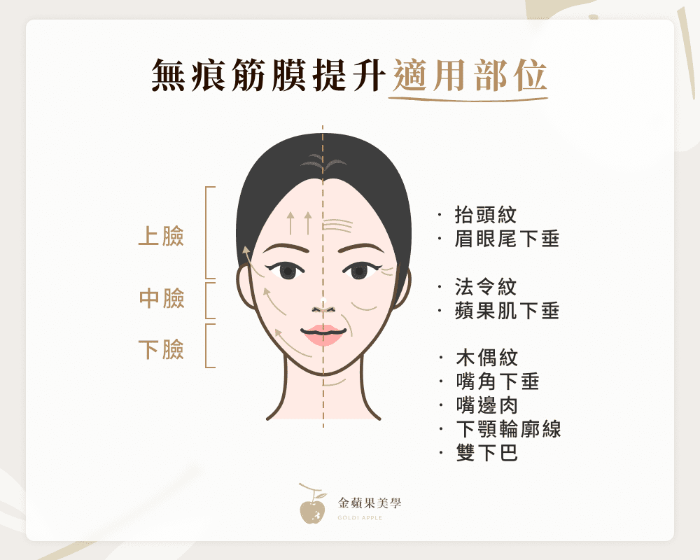 無痕筋膜拉提適用部位:上臉、中臉、下臉
