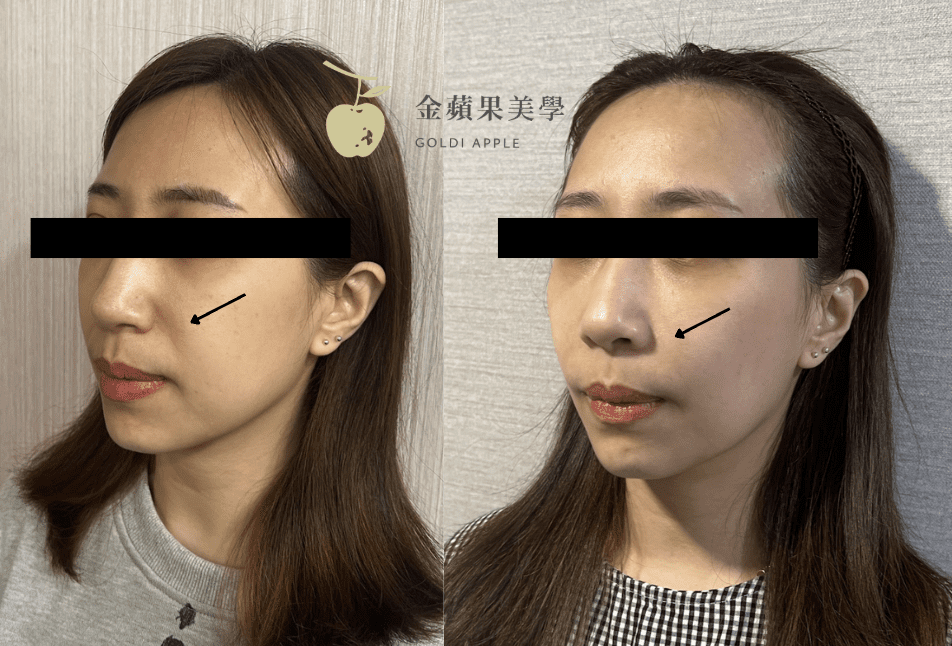 法令紋填充什麼材質好？法令紋玻尿酸、洢蓮絲、薇貝拉、童顏針、晶亮瓷5種比較