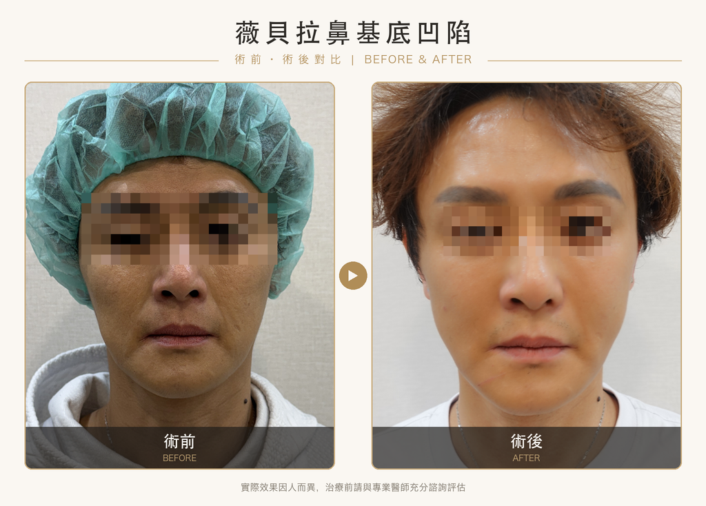 薇貝拉法令紋