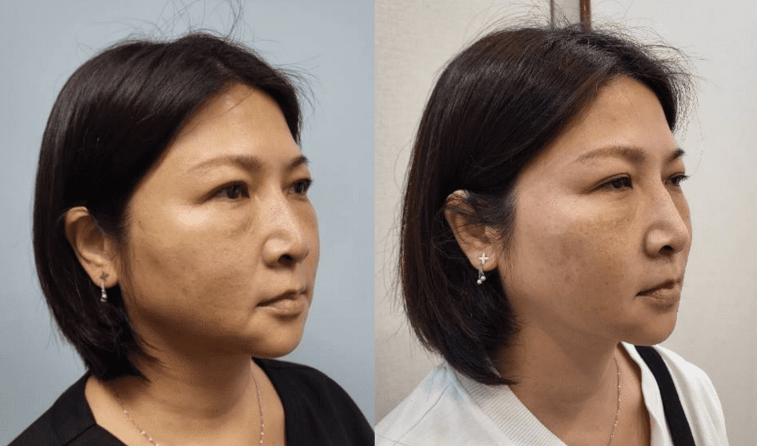 無痕筋膜拉提案例 1:神力拉提埋線改善嘴邊肉與木偶紋