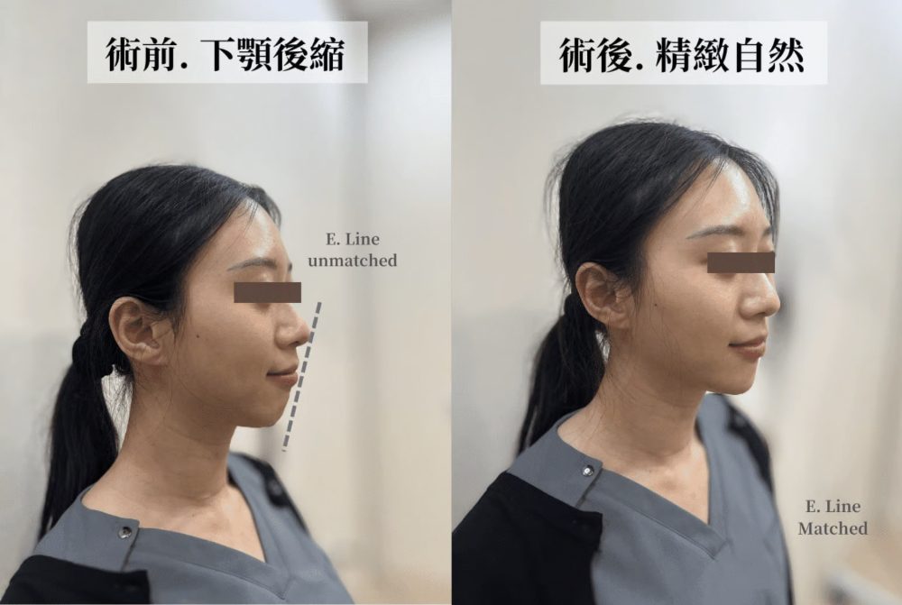 金蘋果美學診所案例 2：打造美觀線（E-Line）