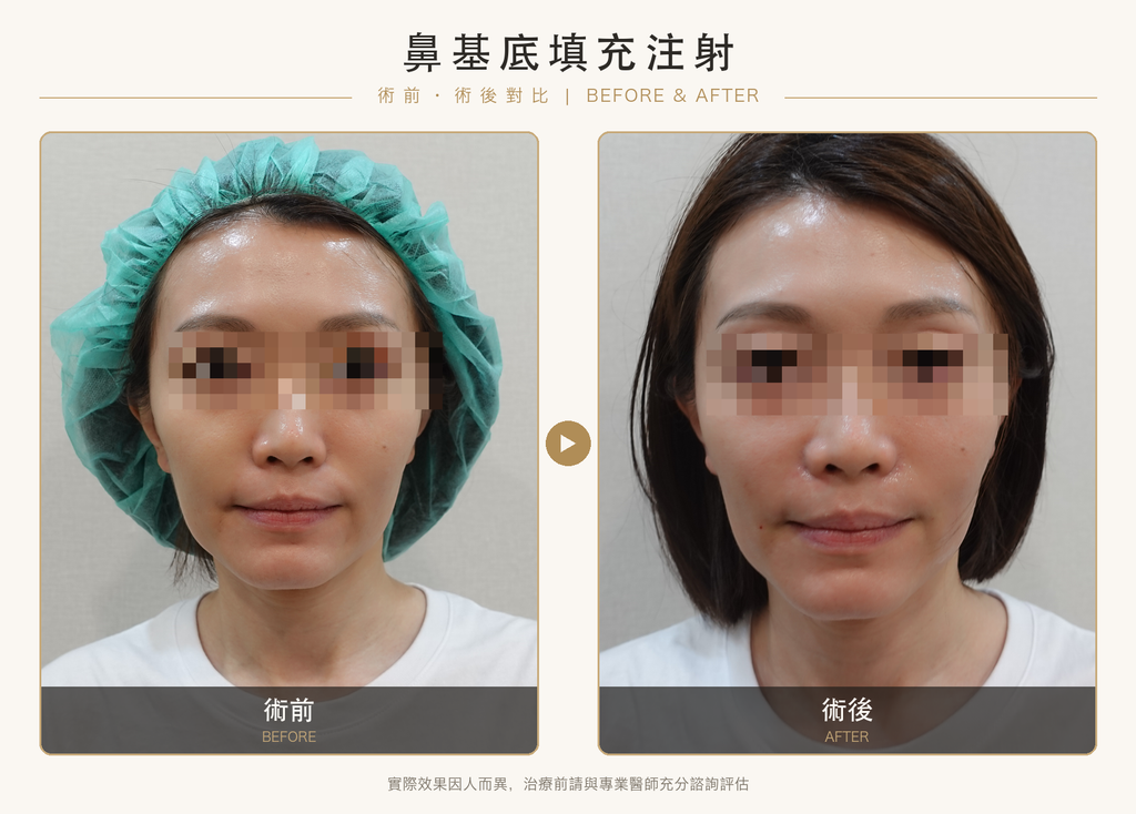 鼻基底凹陷玻尿酸