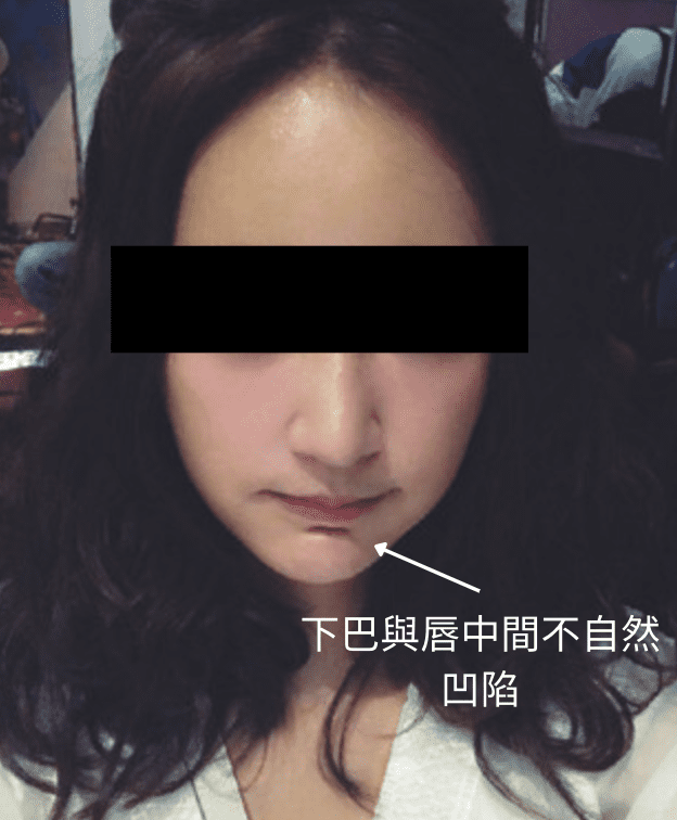 下巴玻尿酸後悔