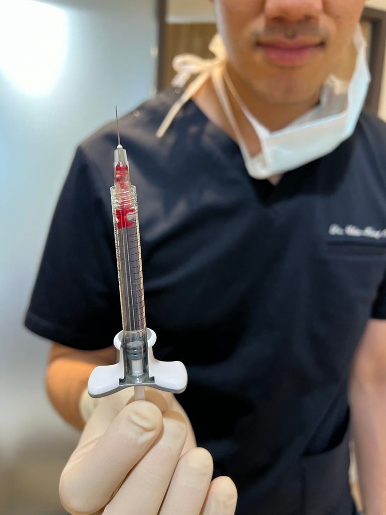 玻尿酸血管栓塞