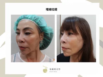 埋線拉提是什麼？埋線拉提原理、線材、費用比較大公開