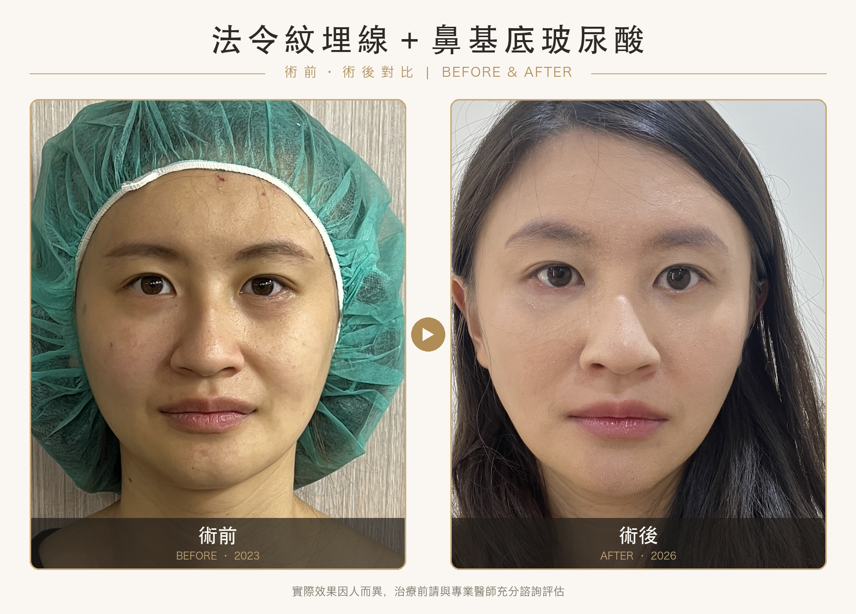 法令紋醫美怎麼選?6 種療程比較、費用與推薦指南
