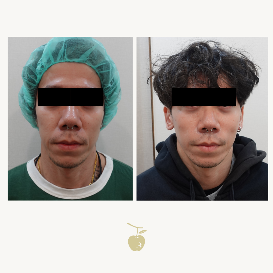 臉下垂怎麼辦?臉下垂的原因與解決方法