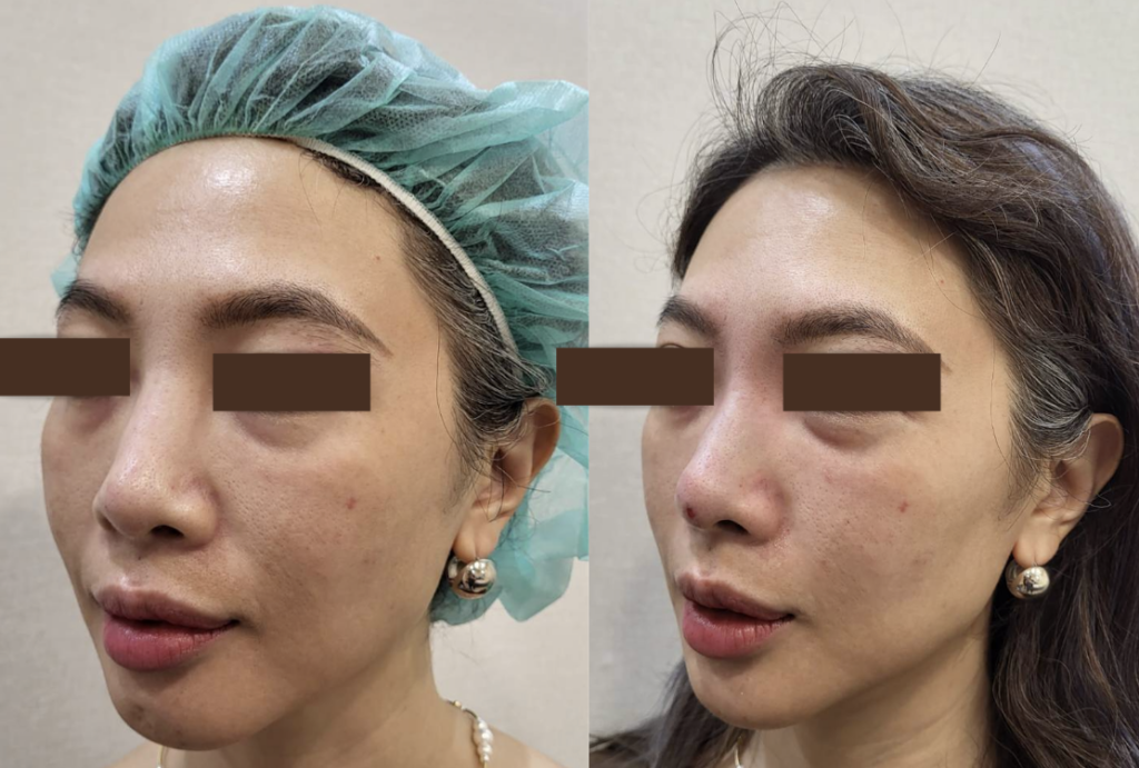 玻尿酸鼻子變寬怎麼辦