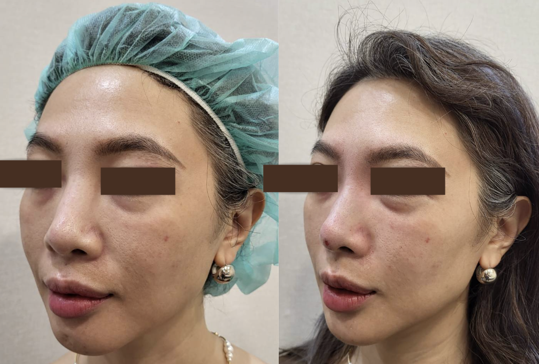 玻尿酸鼻子變寬怎麼辦?山根降解告別納美人