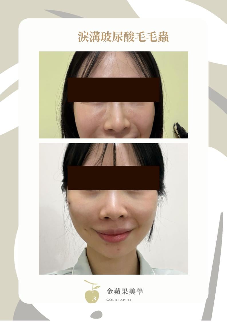 淚溝填補失敗怎麼辦?3種淚溝填補失敗如何處理