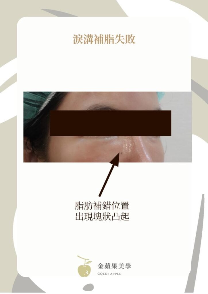 淚溝補脂失敗