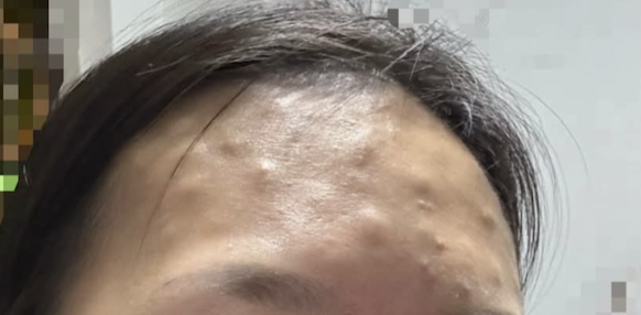喬雅露副作用