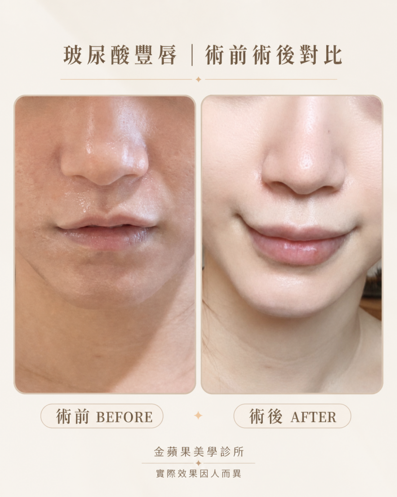 微笑唇玻尿酸