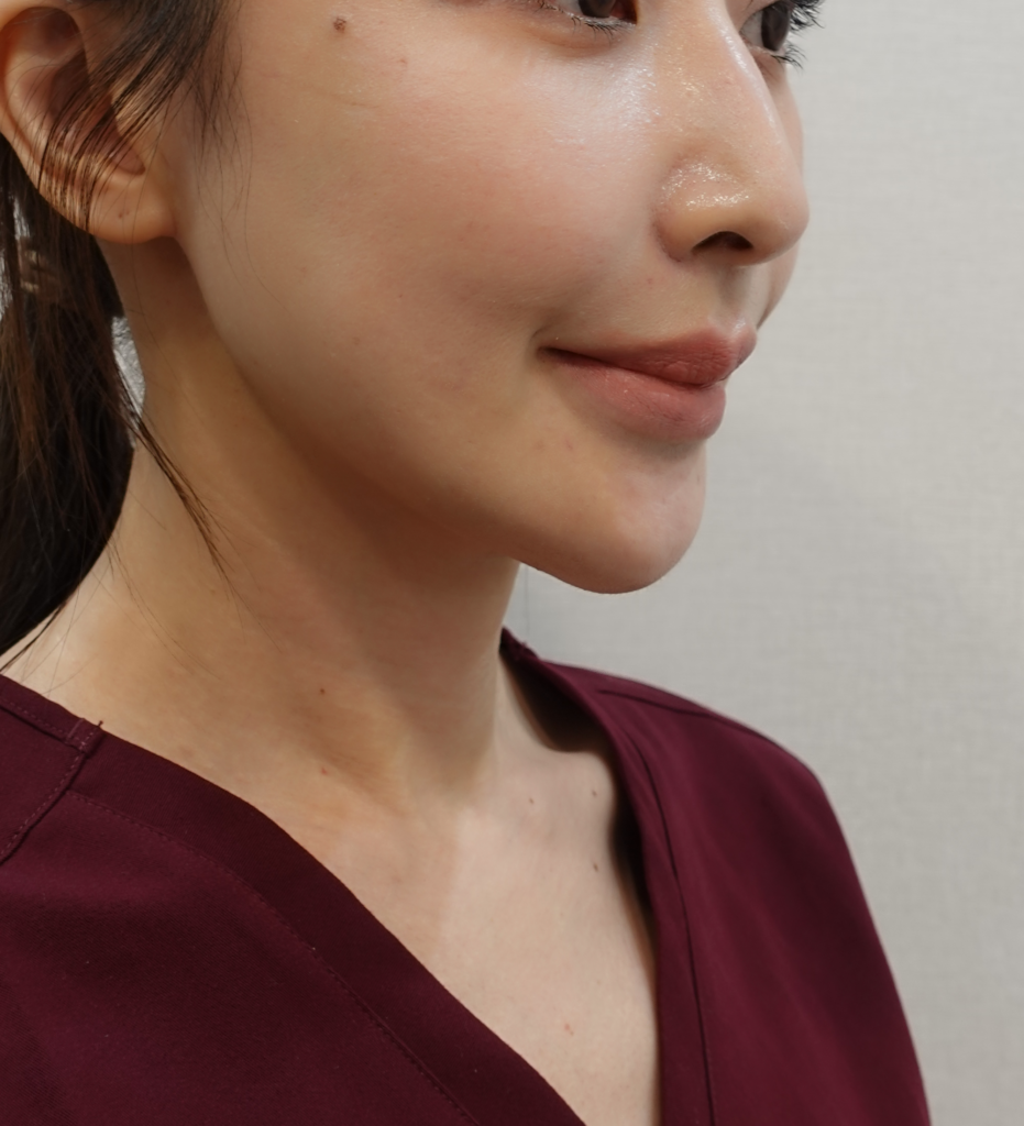 下巴玻尿酸降解