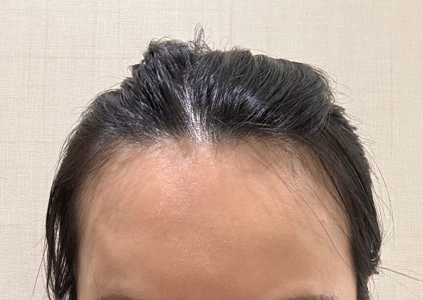 額頭凹凸不平