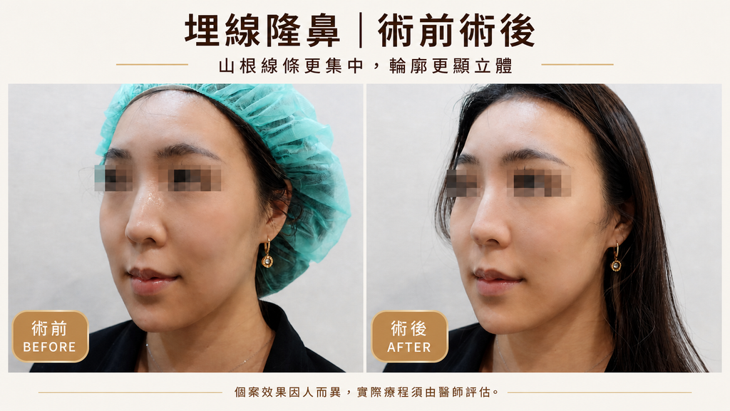 埋線隆鼻案例