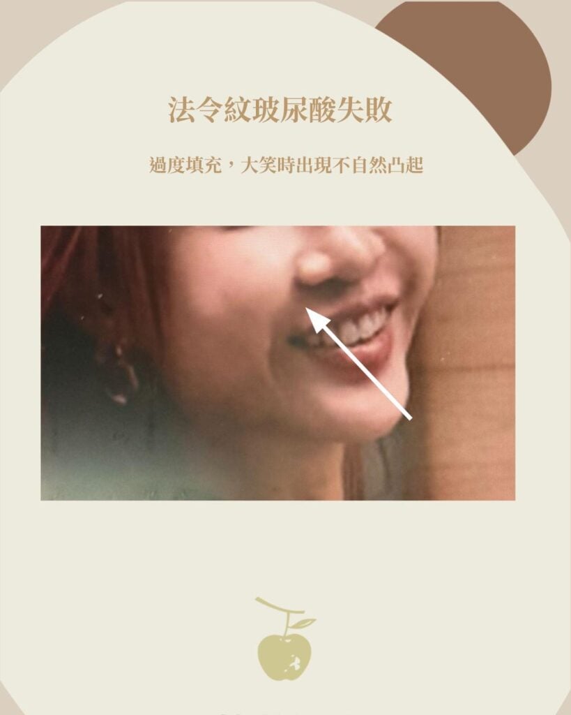 法令紋玻尿酸 猴化