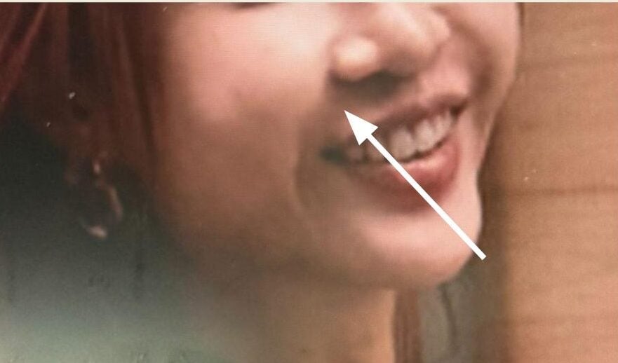 洢蓮絲法令紋失敗