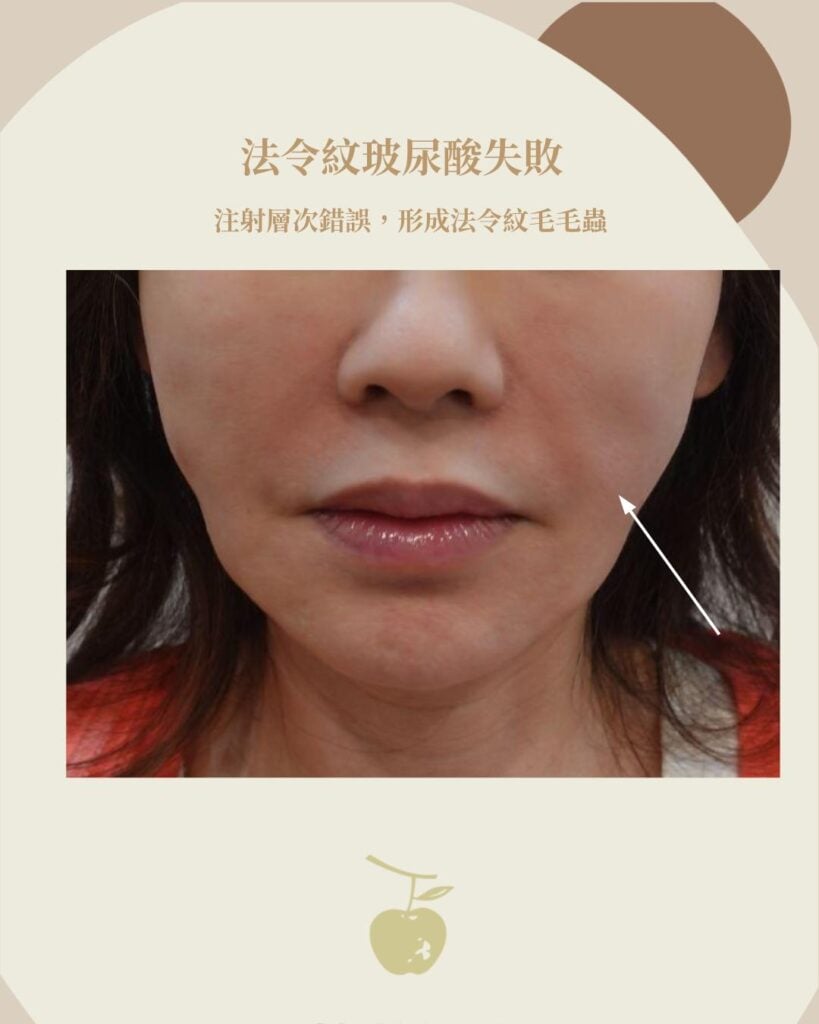 法令紋玻尿酸失敗