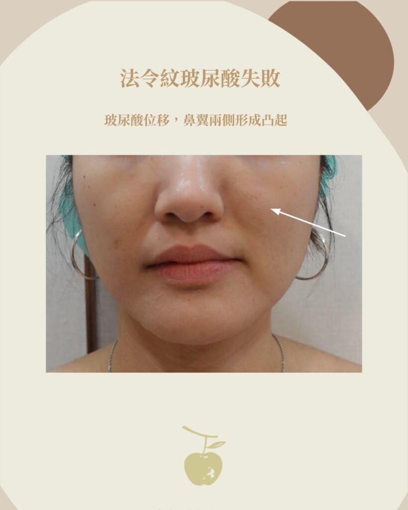 法令紋玻尿酸 位移