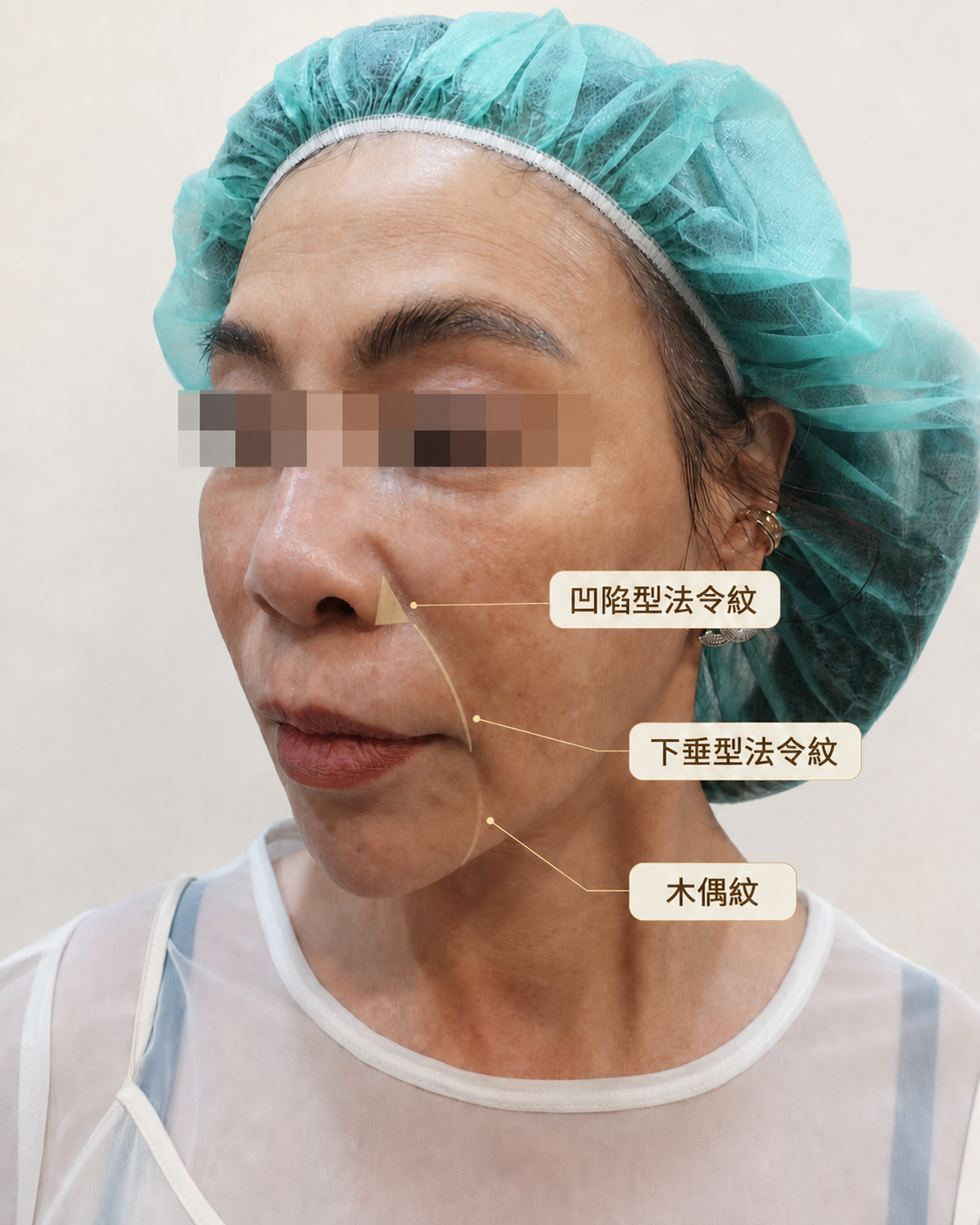 法令紋類型