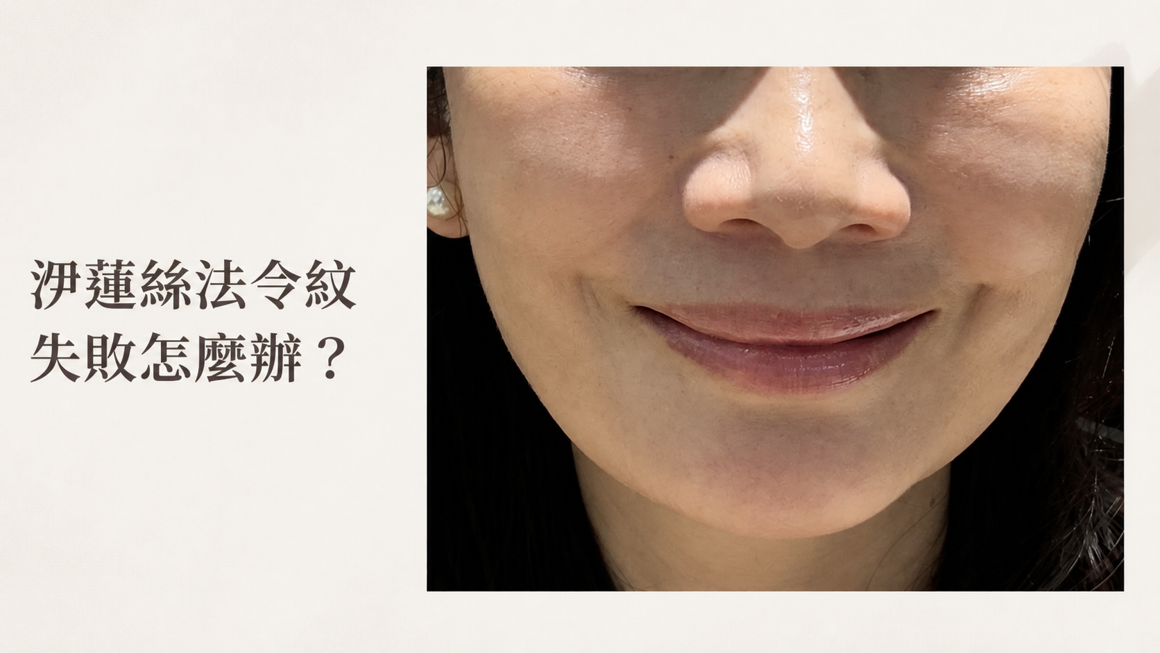 洢蓮絲法令紋失敗怎麼辦?症狀、原因與補救方式完整解析