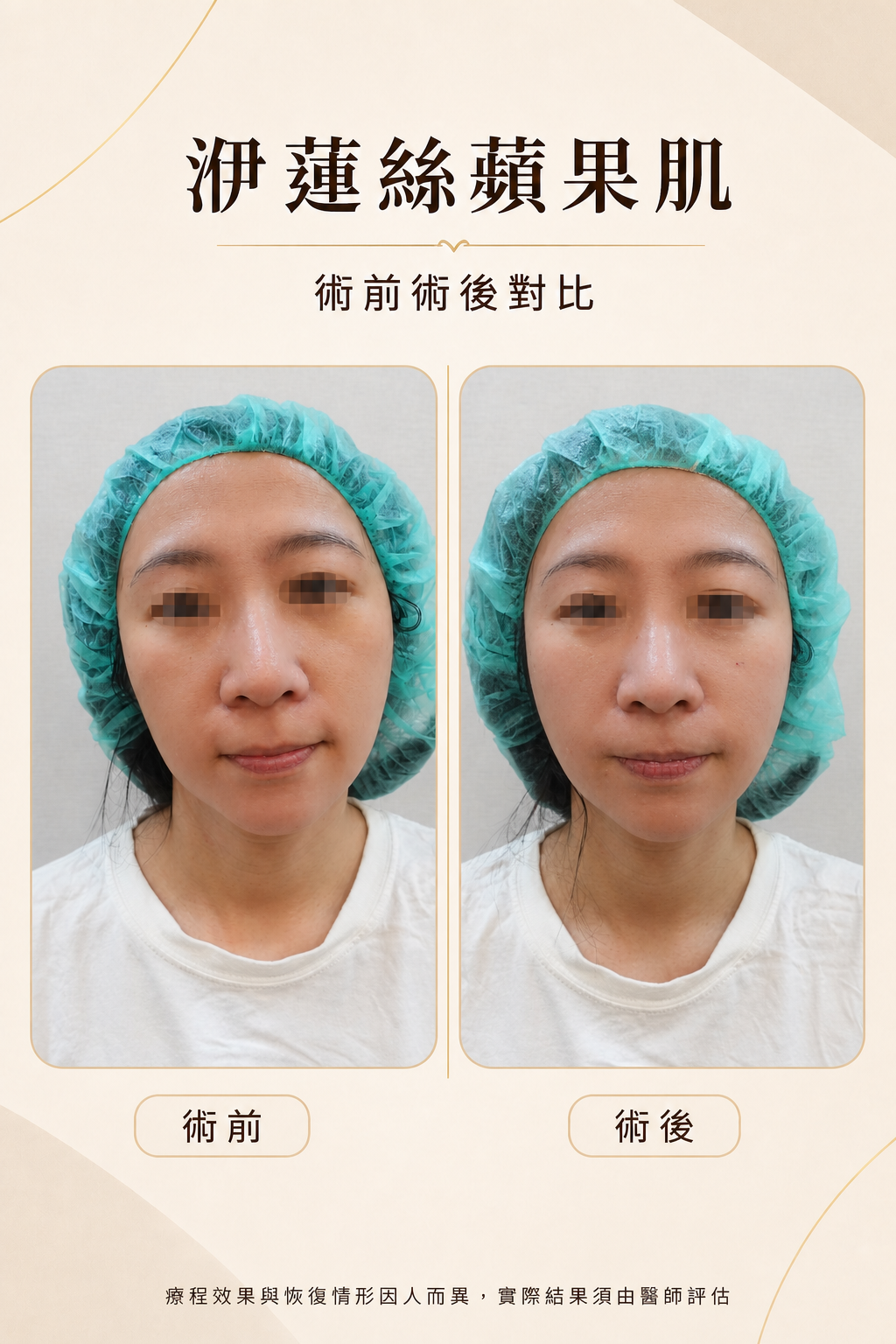 洢蓮絲蘋果肌適合我嗎?有可能洢蓮絲饅化嗎?