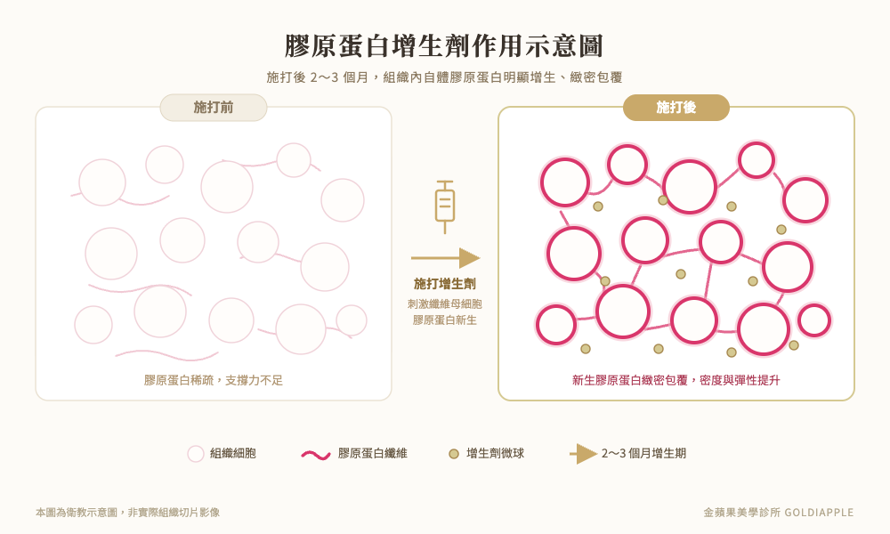 膠原蛋白增生劑 增生過程