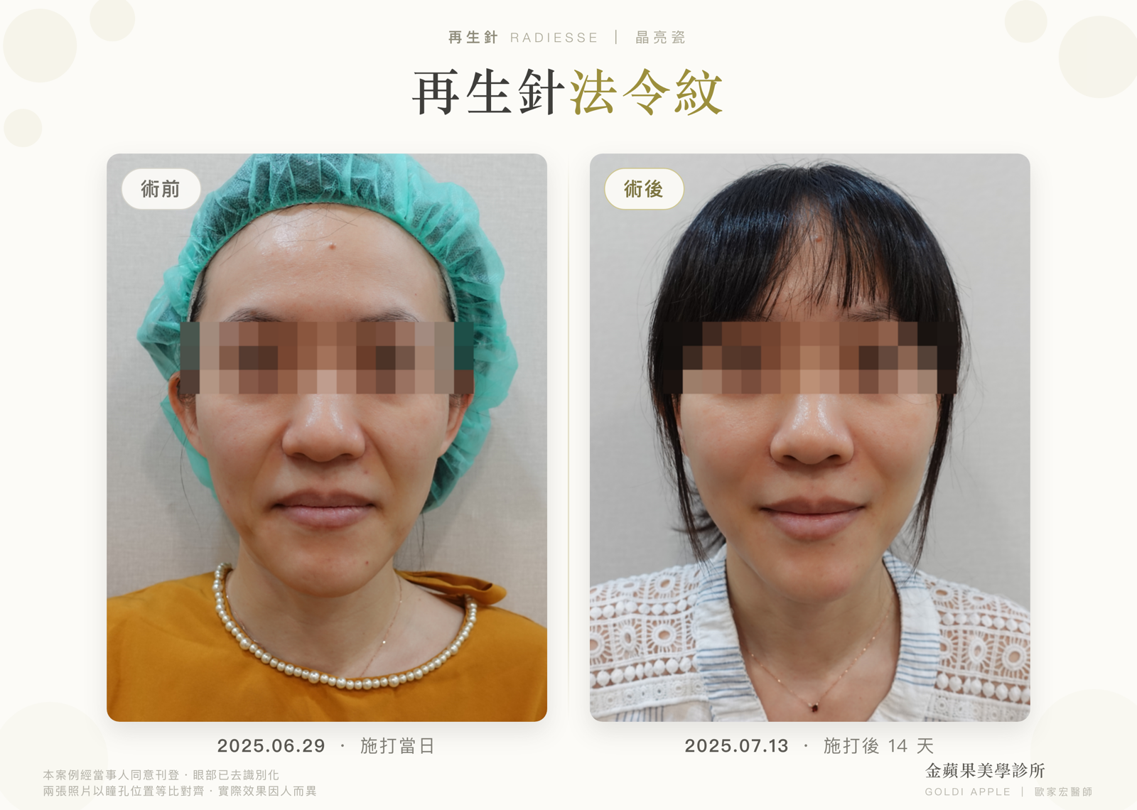 再生針法令紋效果好嗎?不位移、不結節、不饅化的 3 個原因