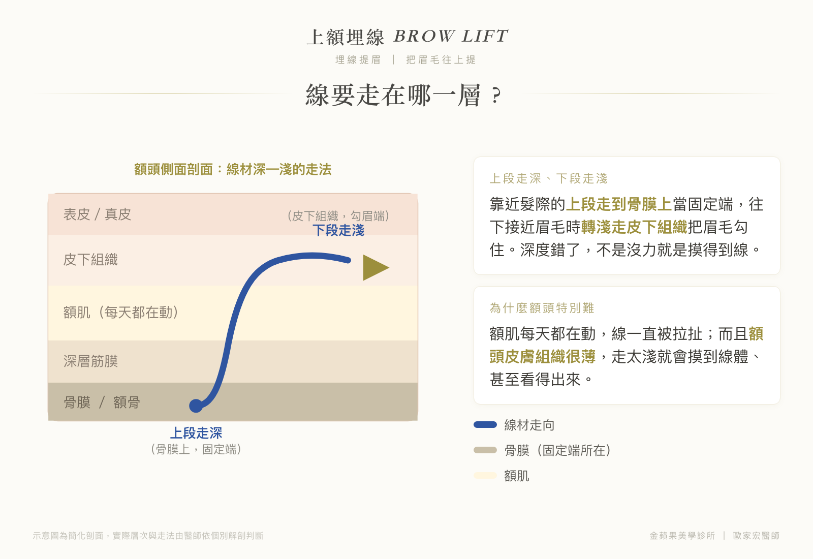 上額埋線走線層次剖面圖:上段走深至骨膜上當固定端,下段轉淺走皮下組織勾住眉毛