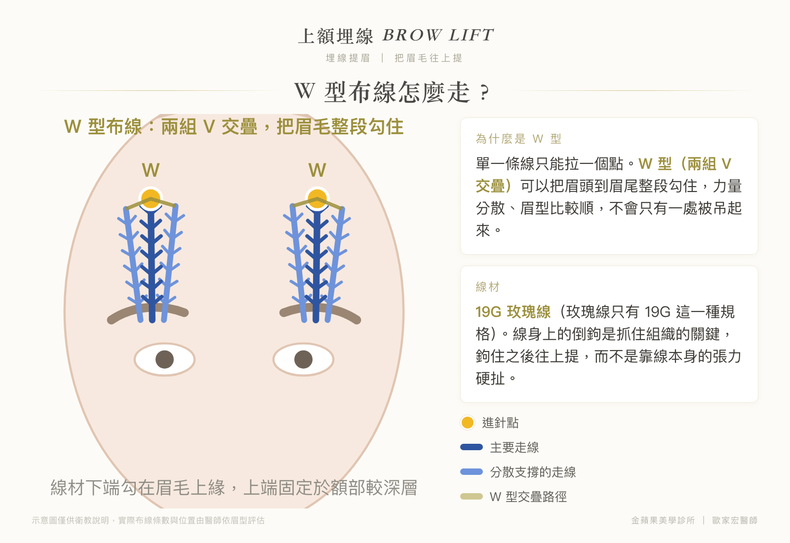 上額埋線 W 型布線示意圖:兩組 V 交疊,19G 玫瑰線倒鉤勾住眉頭到眉尾整段往上提