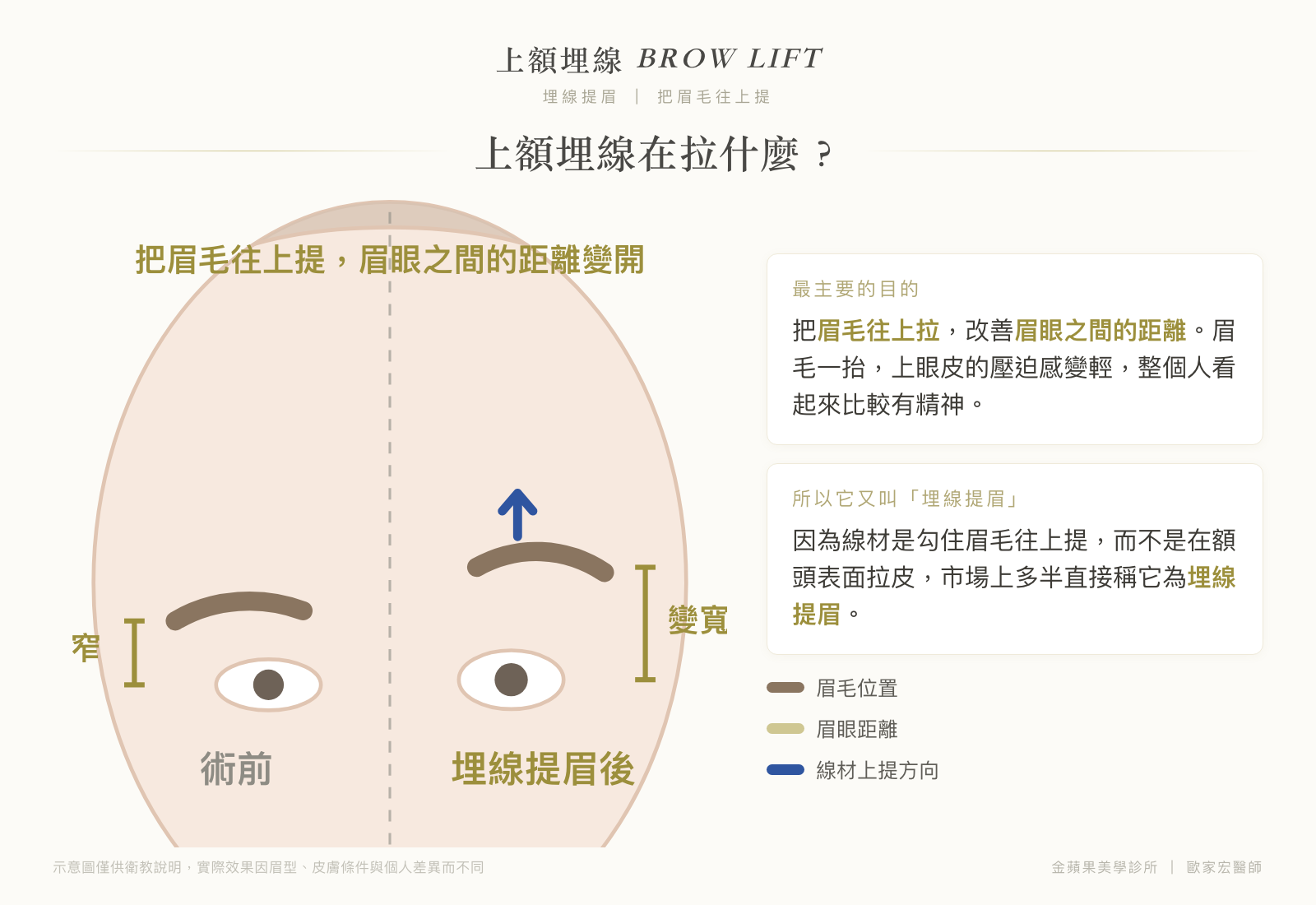 上額埋線(埋線提眉)示意圖:把眉毛往上提,眉眼之間的距離變開,上眼皮壓迫感變輕