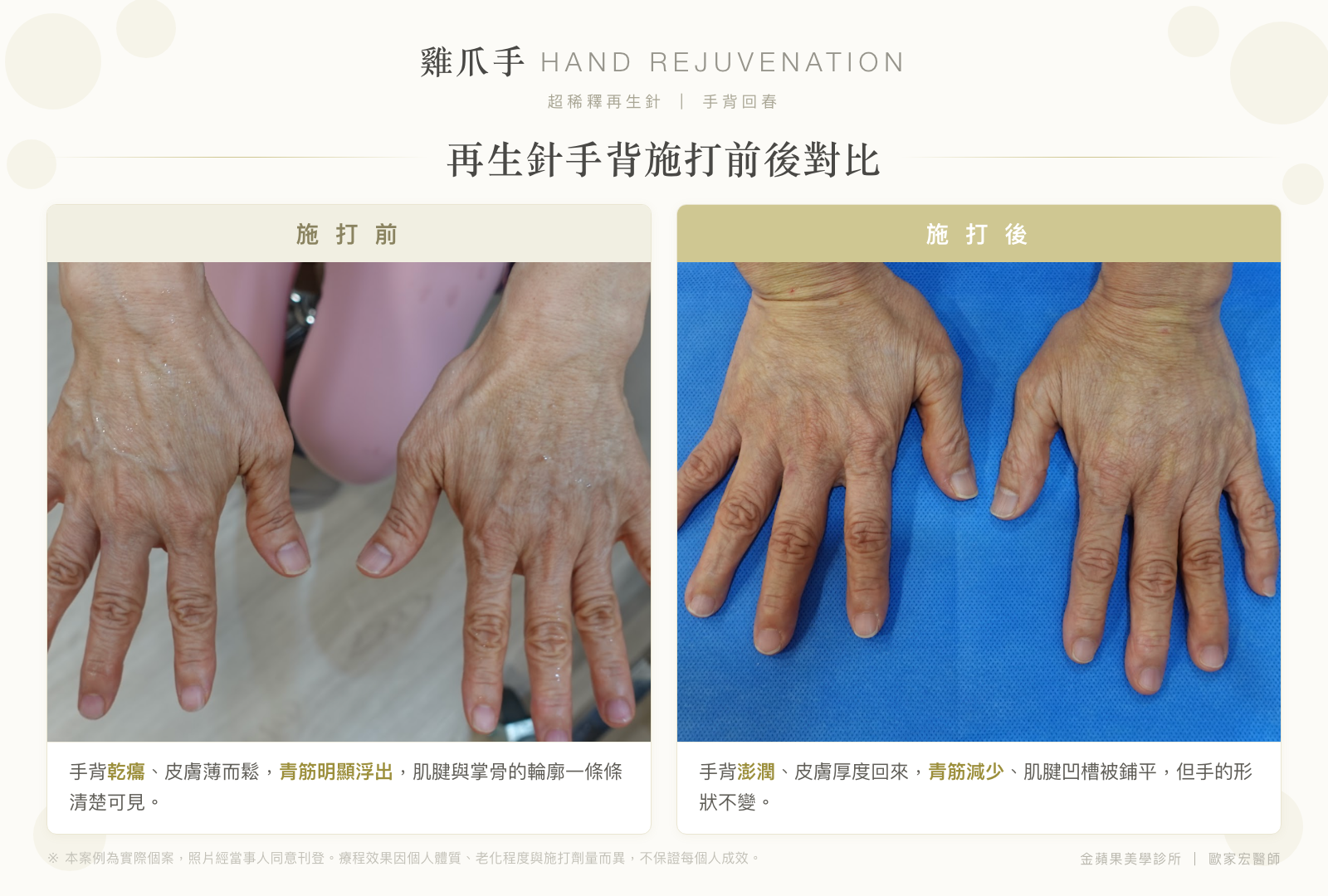 雞爪手再生針手背施打前後對比:施打前手背乾癟、青筋明顯浮出;施打後手背澎潤、青筋減少