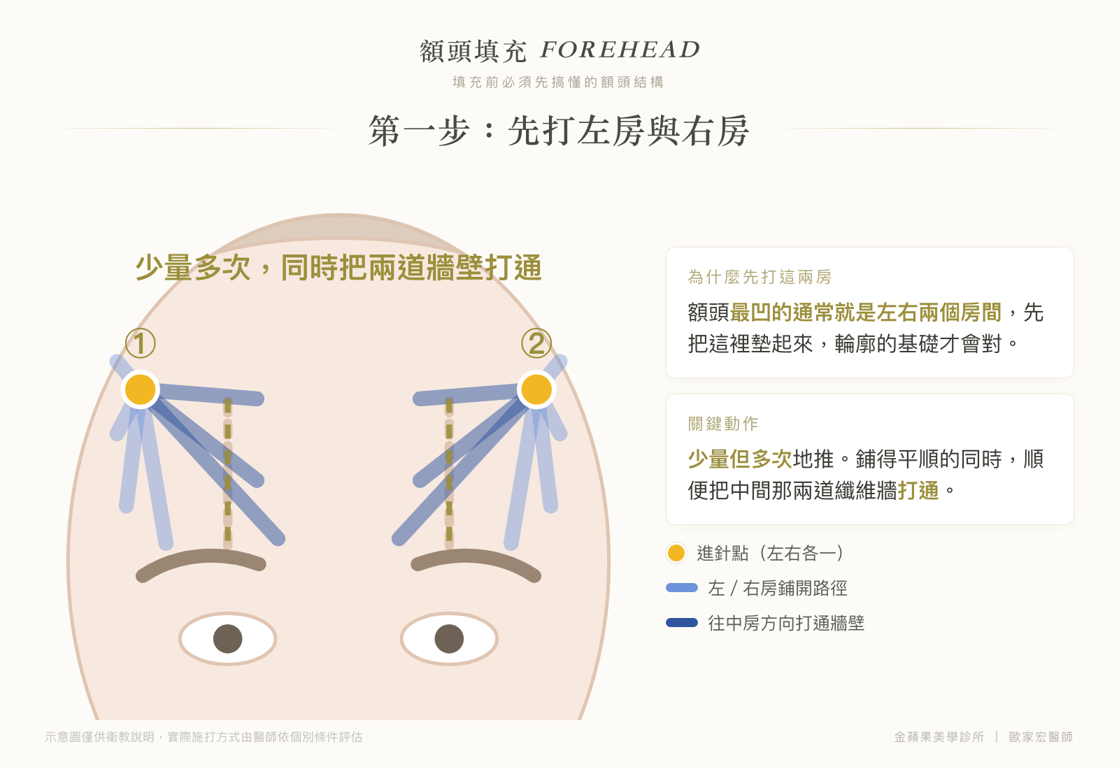 額頭填充第一步示意圖:左右兩個進針點,少量多次鋪開左房與右房,同時打通兩道纖維牆壁