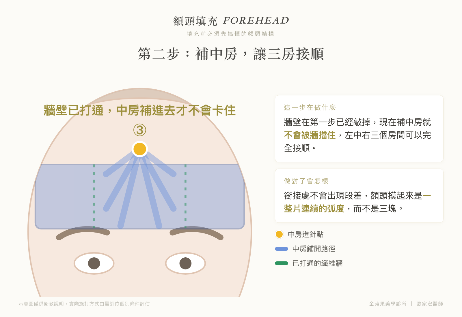 額頭填充第二步示意圖:牆壁打通後補中房,讓左中右三個房間銜接順暢、不出現段差
