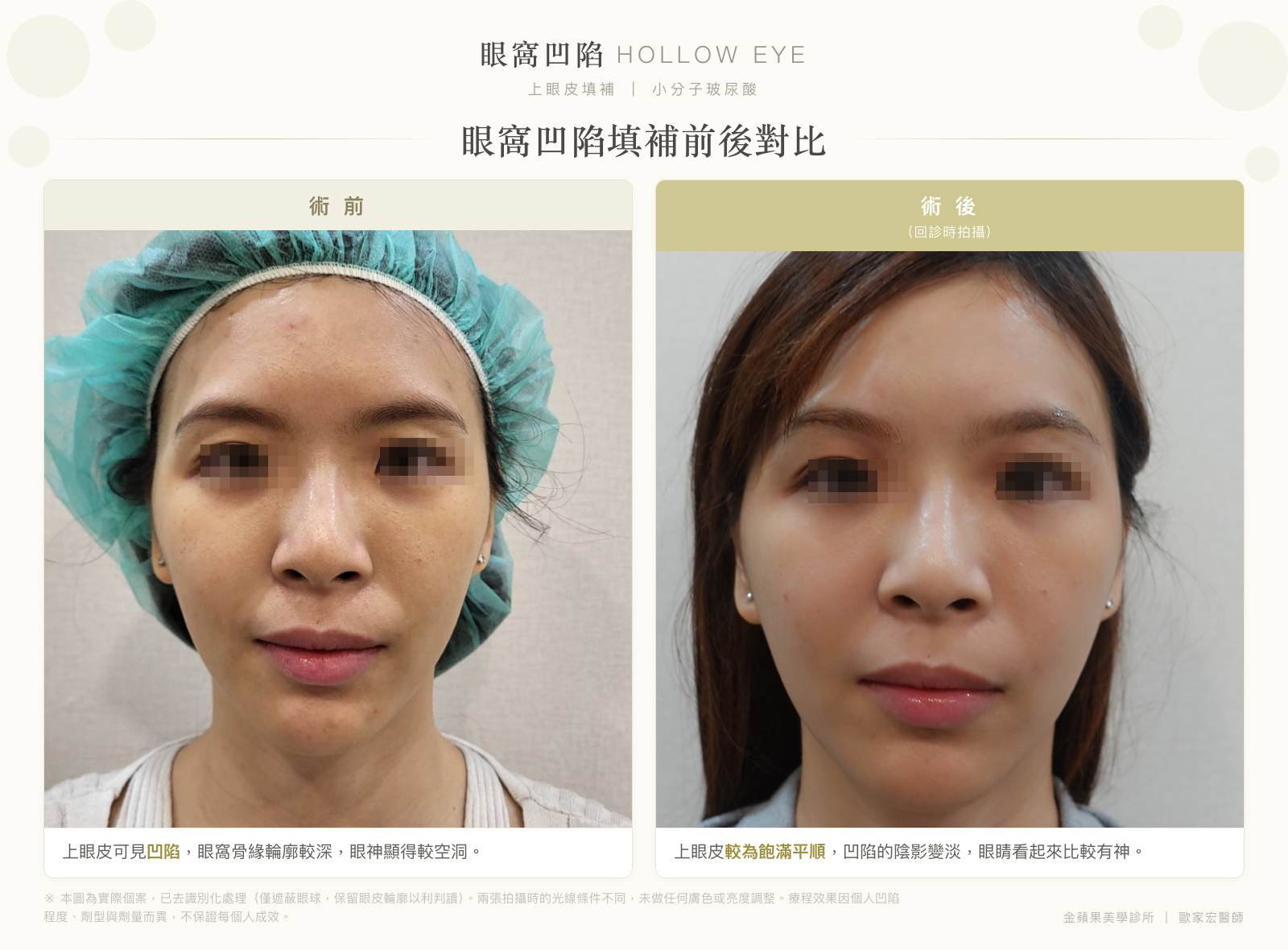 眼窩凹陷填補前後對比:術前上眼皮凹陷、眼窩骨緣輪廓較深;術後上眼皮較飽滿平順,凹陷陰影變淡