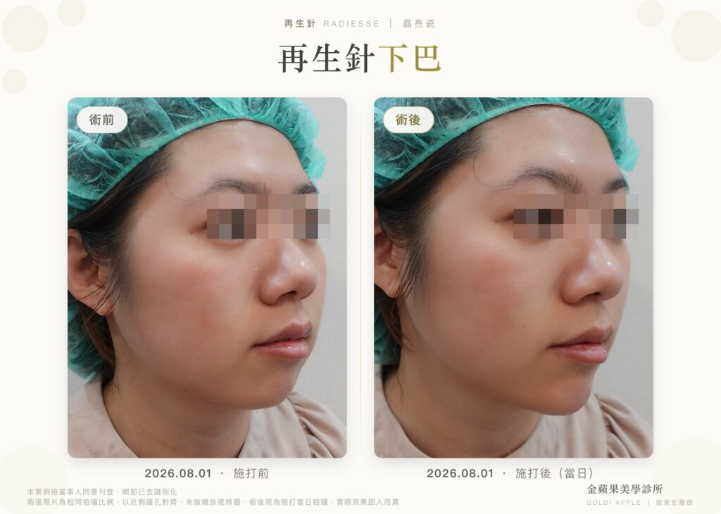 再生針(晶亮瓷)下巴女性案例:施打當日術前術後 45 度側臉對照,眼部已去識別化